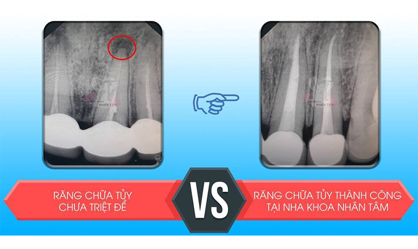 điều trị tủy răng tại Nha khoa Nhân Tâm