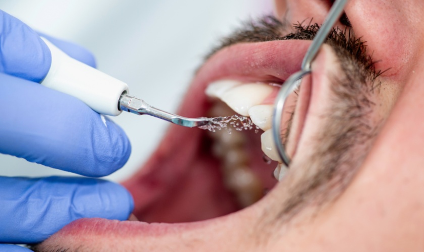 Cạo vôi răng tại nha khoa uy tín sẽ loại bỏ triệt để vôi răng