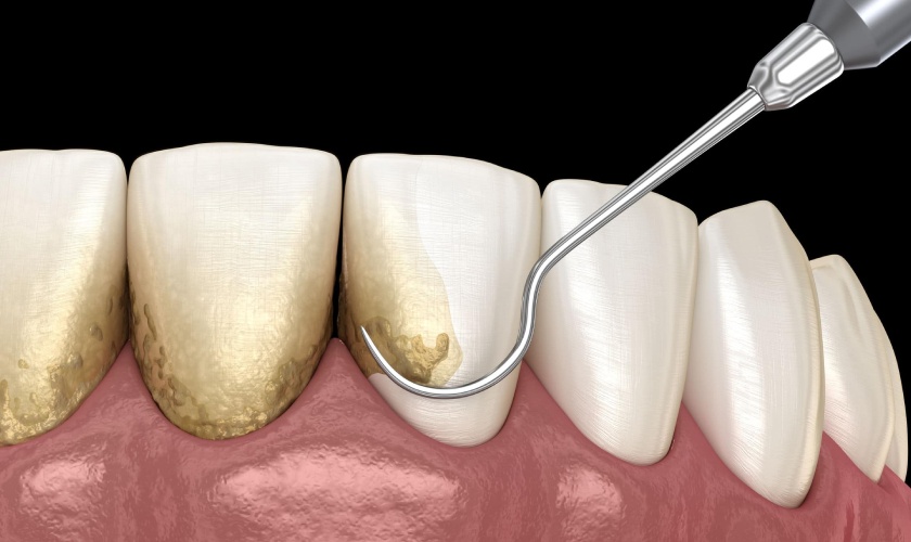 Giá cạo vôi răng là khác nhau ở mỗi nha khoa