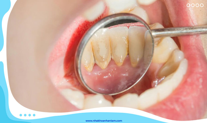 Cạo vôi răng có đau không còn tùy thuộc mức độ vôi nhiều hay ít