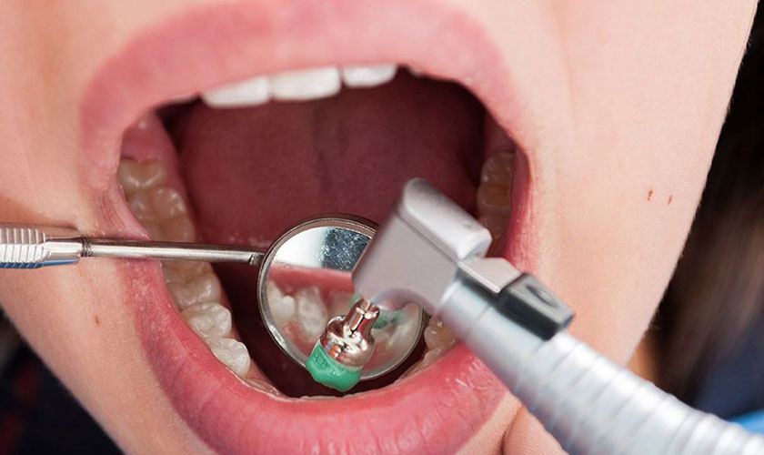 Giá cạo vôi răng sẽ tùy thuộc vào tình trạng vôi răng của bạn nhiều hay ít, trên bề mặt răng hay dưới nướu