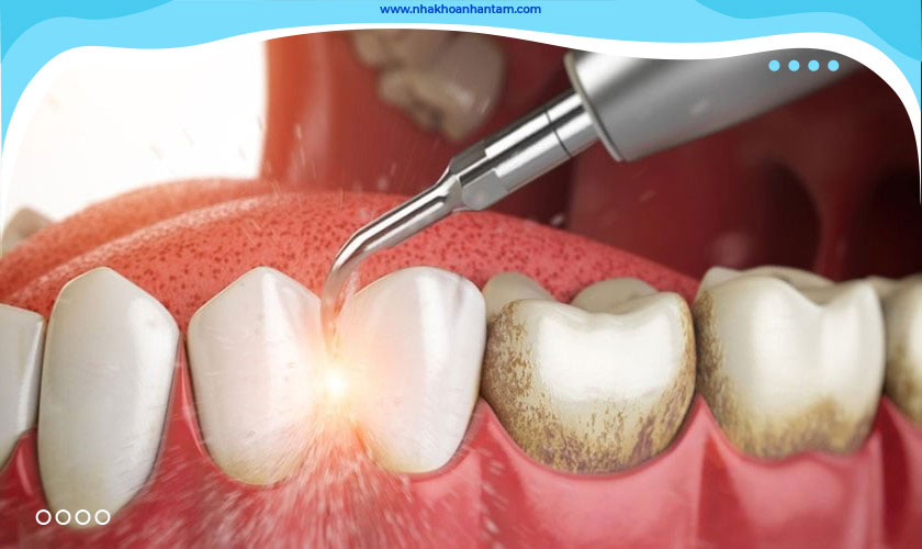 Vôi răng cần được loại bỏ để tránh gây các bệnh lý về răng miệng