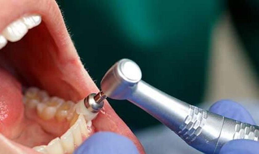 Cạo vôi và đánh bóng răng