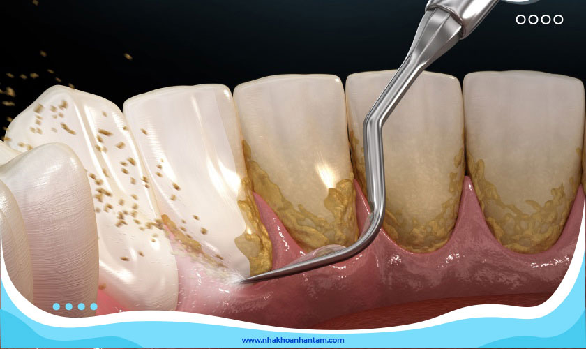 Cần lựa chọn nha khoa uy tín để cạo vôi răng an toàn