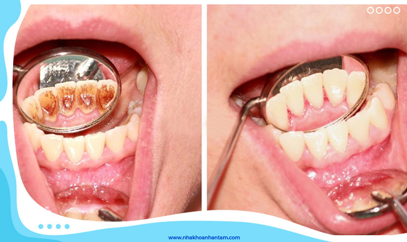 Loại bỏ hoàn toàn vôi răng với Nha khoa Nhân Tâm