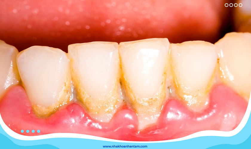 Vôi răng nếu để lâu ngày sẽ gây nên những tác hại khôn lường