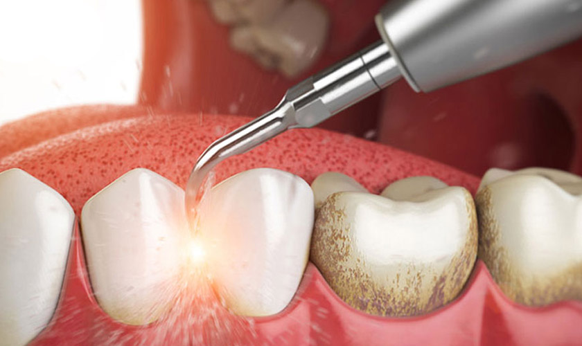 Giá cạo vôi răng còn tùy thuộc vào lượng vôi nhiều hay ít