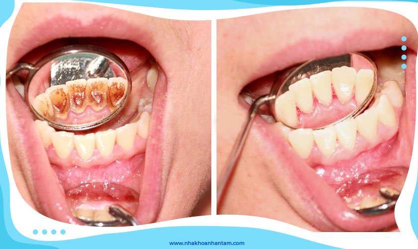 Cạo vôi răng giúp răng chắc khỏe
