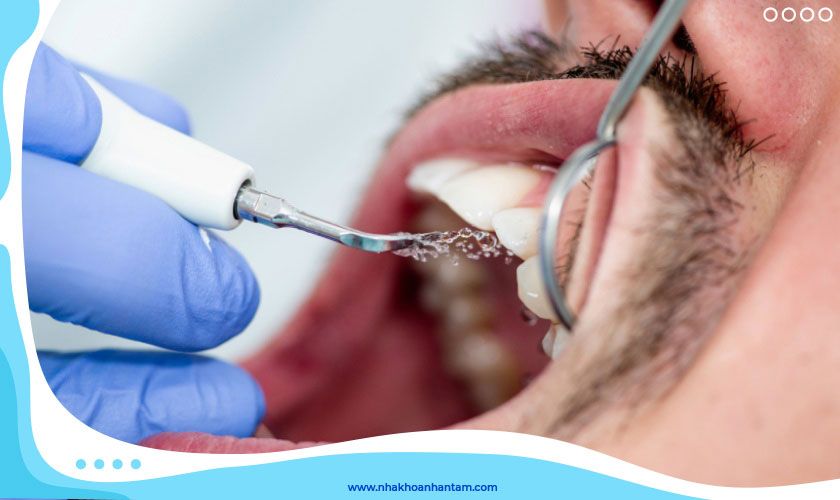Cạo vôi răng bằng sóng siêu âm được thực hiện nhẹ nhàng, không đau