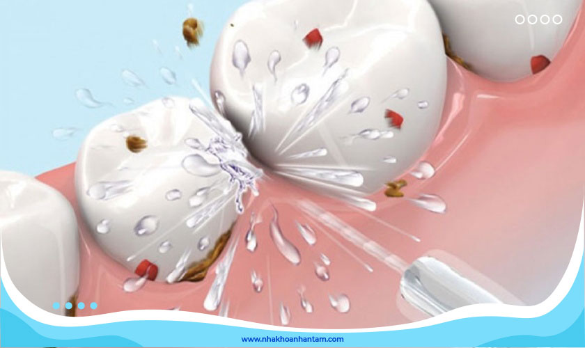 Máy cạo vôi răng sở hữu nhiều ưu điểm vượt trội