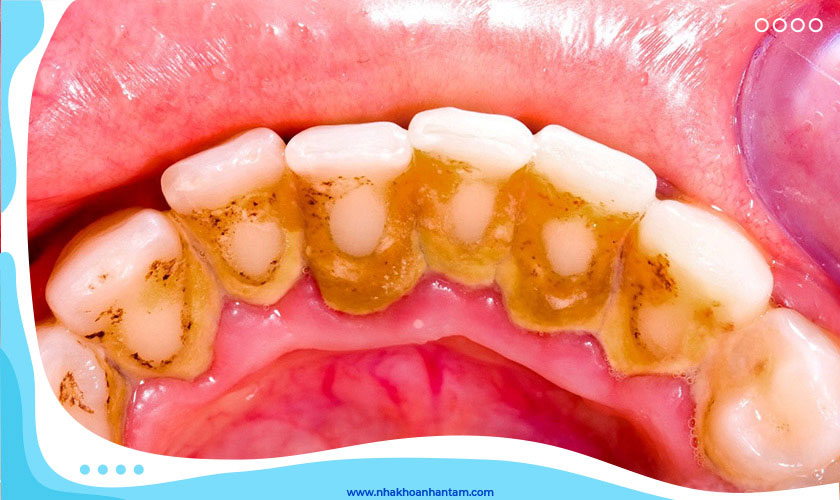 Vôi răng Vôi răng