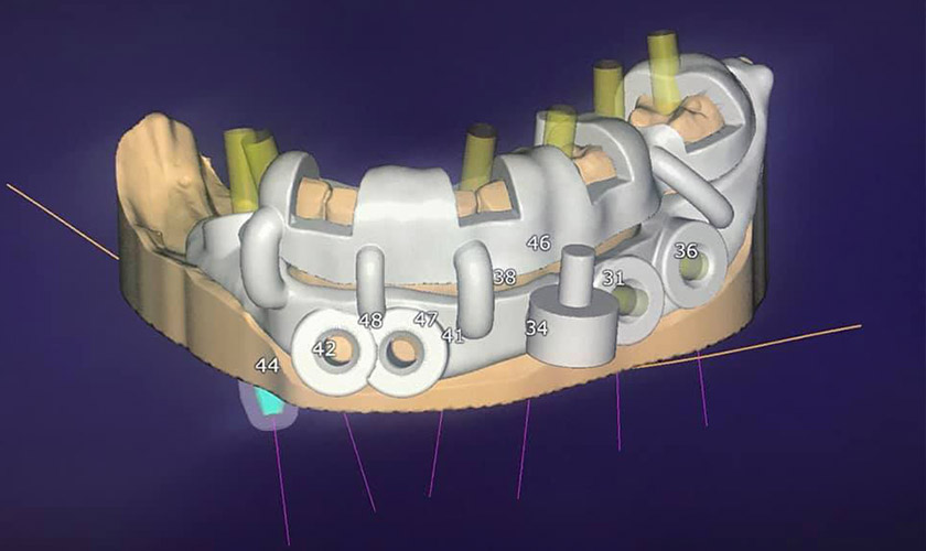 Máng hướng dẫn cấy ghép Implant Máng hướng dẫn cấy ghép Implant nhiều tầng tại Nha khoa Nhân Tâm