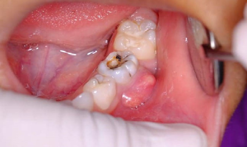 Dấu hiệu nhận biết áp xe chân răng