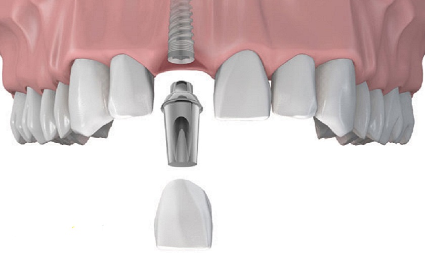 Sau khi nhổ răng cần phục hình lại trong thời gian sớm nhất