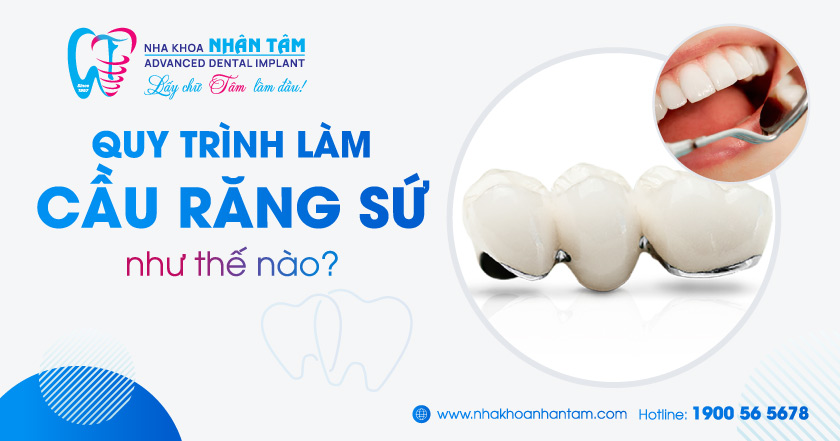 Quy trình mắc cầu răng sứ diễn ra như thế nào?