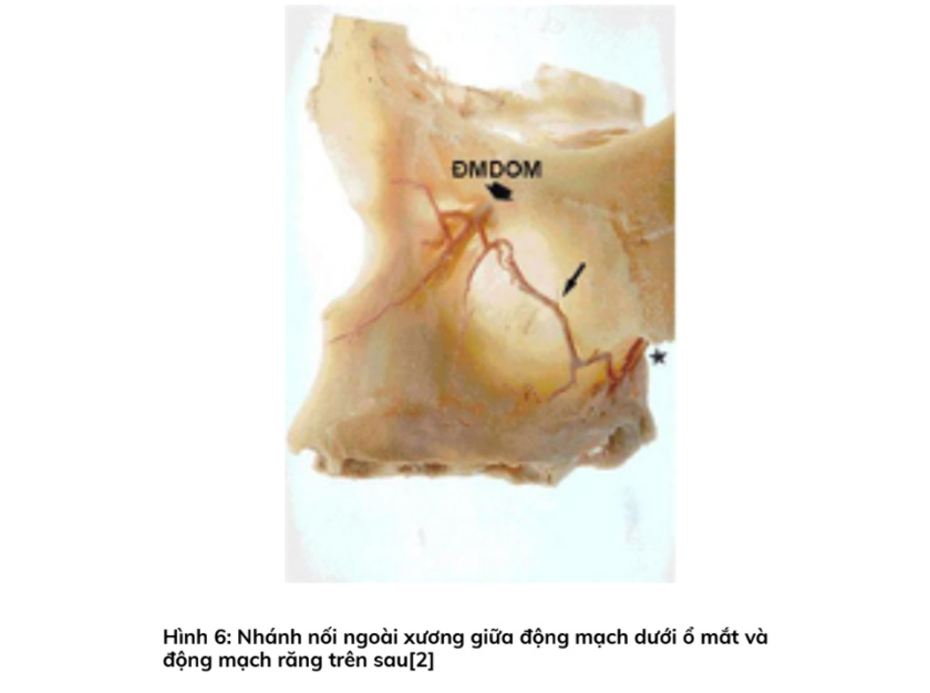 Nhánh nối ngoài xương giữa động mạch dưới ổ mắt và động mạch răng trên sau