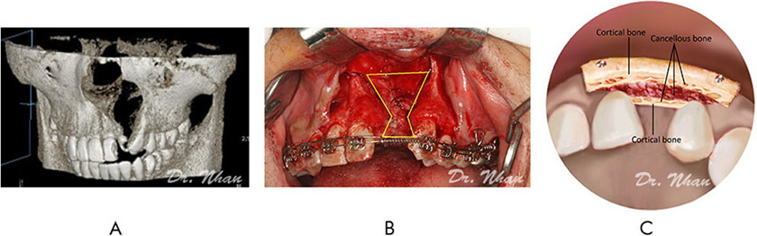 Bone grafting technique. (A) The alveolar cleft on CT Cone Beam. (B) Size of the alveolar defect (yellow line). (C) The technique of two iliac corticocancellous-block grafting.