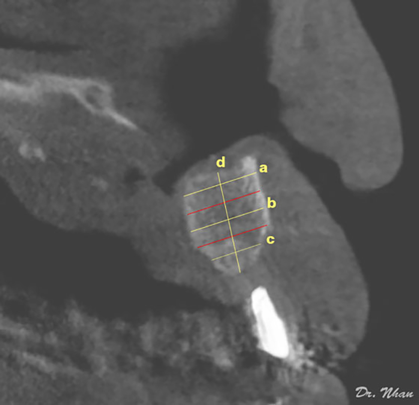 Radiographic assessment of grafted bone: height and width measurements on an axial computed tomographic slice
