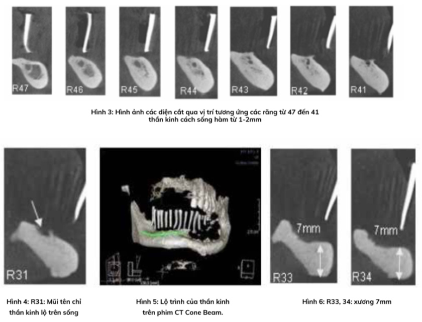 Hình ảnh các diện cắt qua vị trí tương ứng