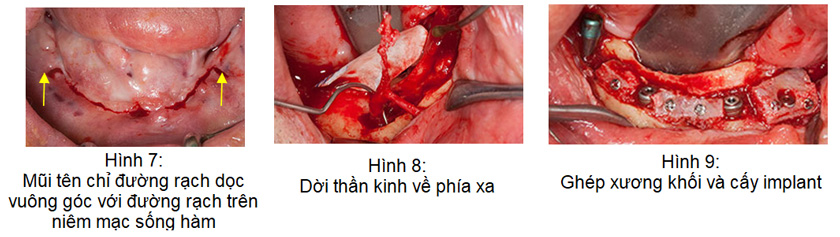 Hình ảnh phẫu thuật