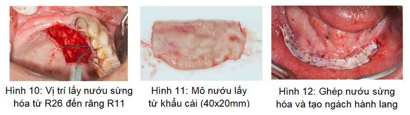 Hình ảnh ghép nướu