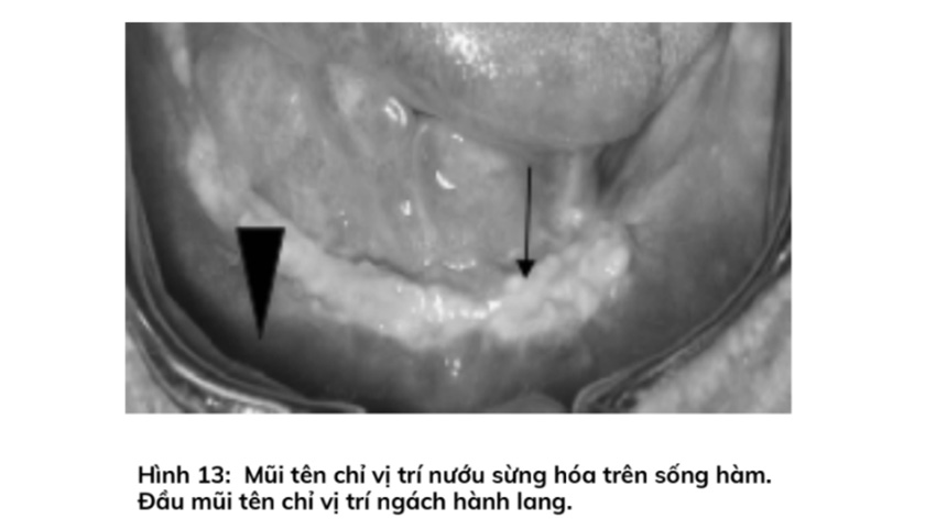Hình ảnh vị trí nướu sừng hóa trên sống hàm
