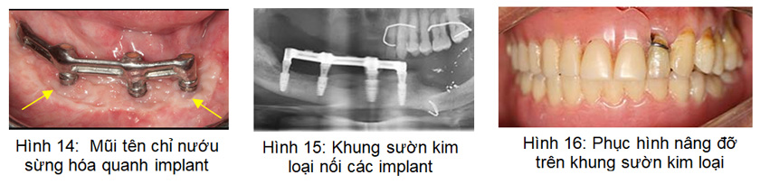Phẫu thuật dời thần kinh ổ răng dưới và cấy ghép Implant