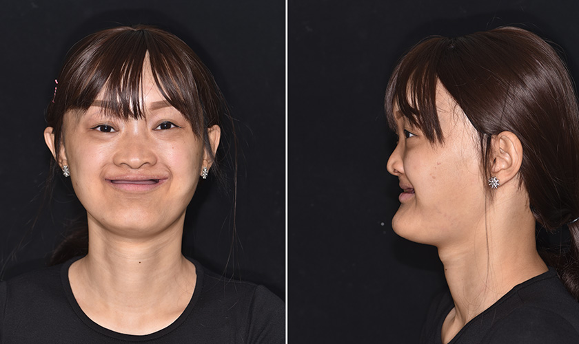 Bệnh nhân Nguyễn Ngọc Hạnh trước khi phẫu thuật