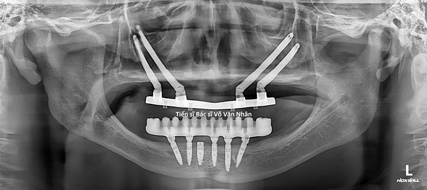 Phim XQ cấy ghép Implant của bệnh nhân không răng bẩm sinh