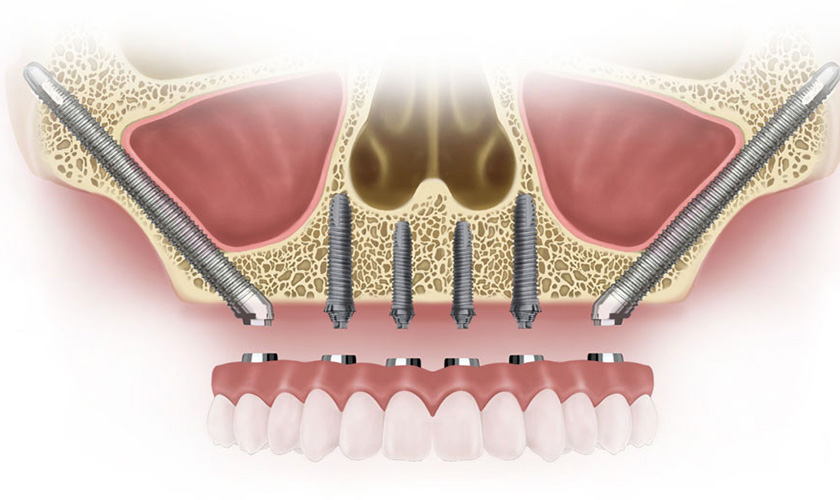 Trồng răng bằng cấy Implant xương gò má