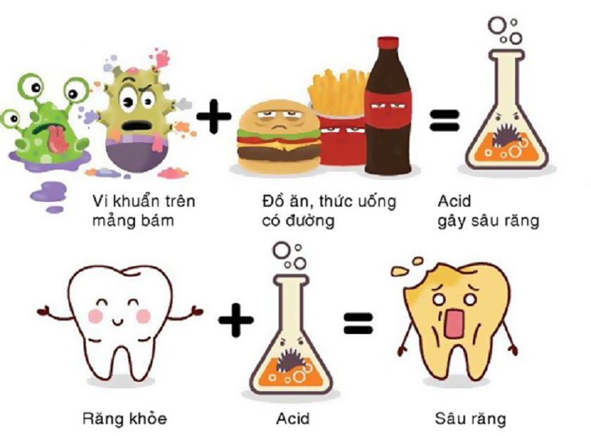 Nguyên nhân sâu răng trẻ em Nguyên nhân sâu răng trẻ em