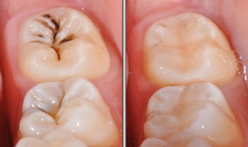 Điều trị sâu răng ở trẻ em bằng trám răng Điều trị sâu răng ở trẻ em bằng trám răng