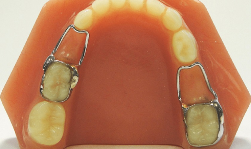 Đeo hàm giữ khoảng để cấy ghép Implant phục hình răng mất khi trẻ đủ tuổi Đeo hàm giữ khoảng để cấy ghép Implant phục hình răng mất khi trẻ đủ tuổi