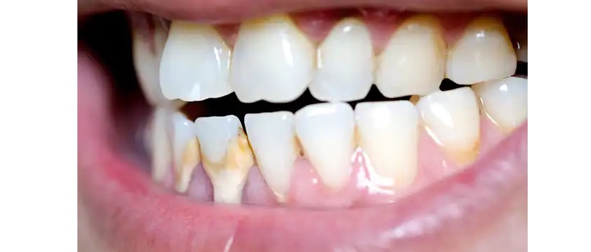 Mảng bám trên răng