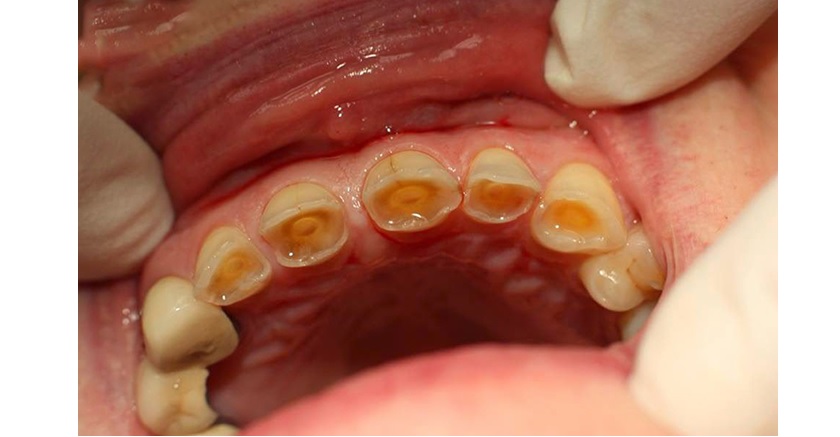 Răng bị mòn mặt nhai do nhiều yếu tố khác nhau tác động