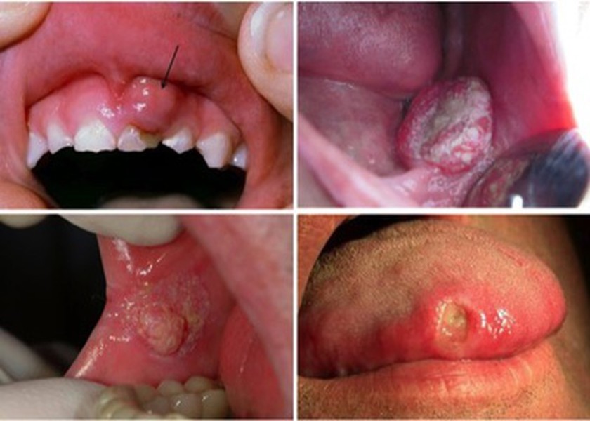 Chăm sóc răng miệng sai cách dẫn đến nhiều bệnh lý nghiêm trọng