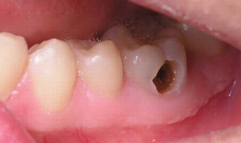 Sâu răng là nguyên nhân hàng đầu gây đau răng bên phải