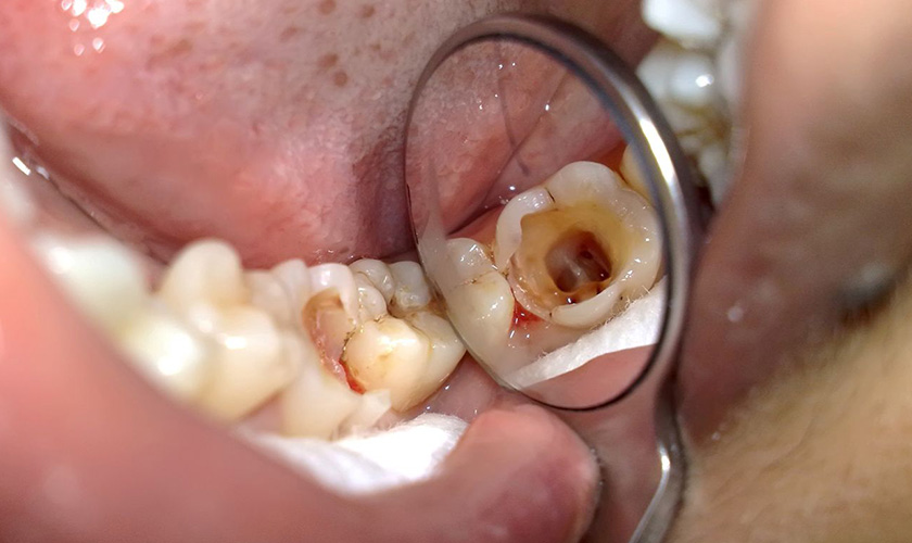 Sâu răng gây ê buốt răng