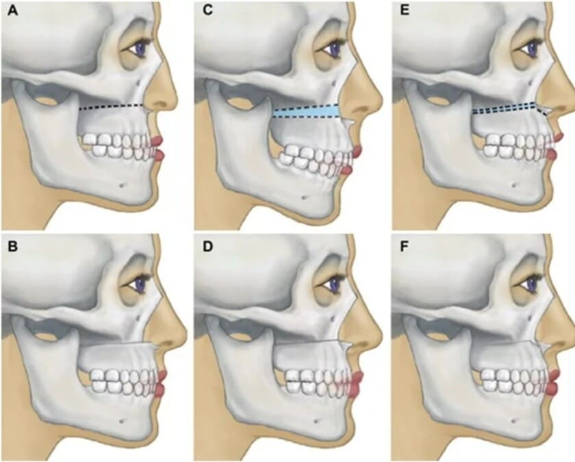 Răng vẩu do xương hàm cần can thiệp phẫu thuật để chỉnh lại cấu trúc xương hàm