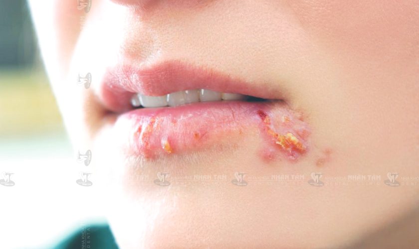 Bệnh Herpes môi