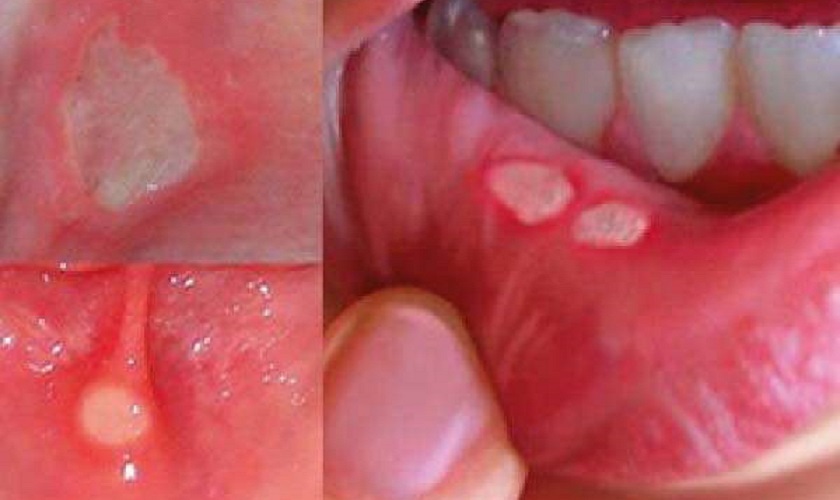 Tình trạng nhiệt miệng