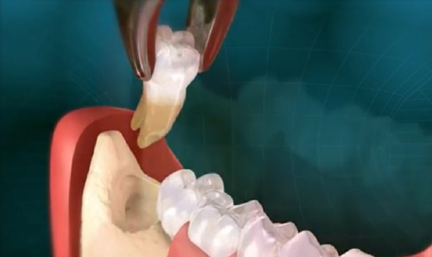 Nhổ răng khôn khi chúng mọc bất thường gây ảnh hưởng đến sức khỏe