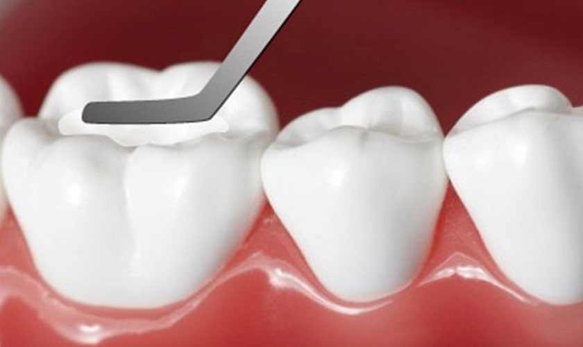 Trám răng chữa trị sâu răng mức độ nhẹ