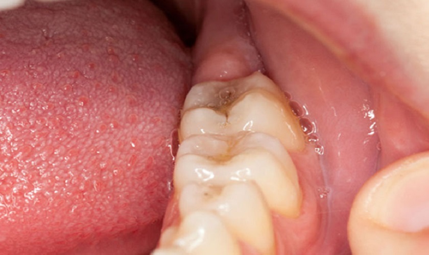 Răng khôn mọc lệch có thể là nguyên nhân gây sưng nướu răng trong cùng hàm dưới?
