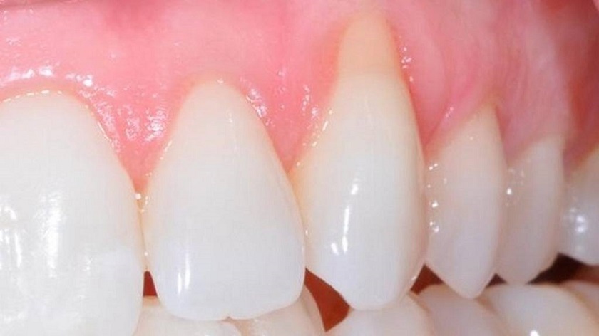 Hiện tượng tụt lợi khi bọc răng sứ bị hỏng