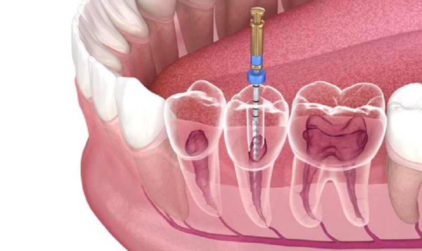 Nên bọc răng sứ sau khi điều trị tủy răng
