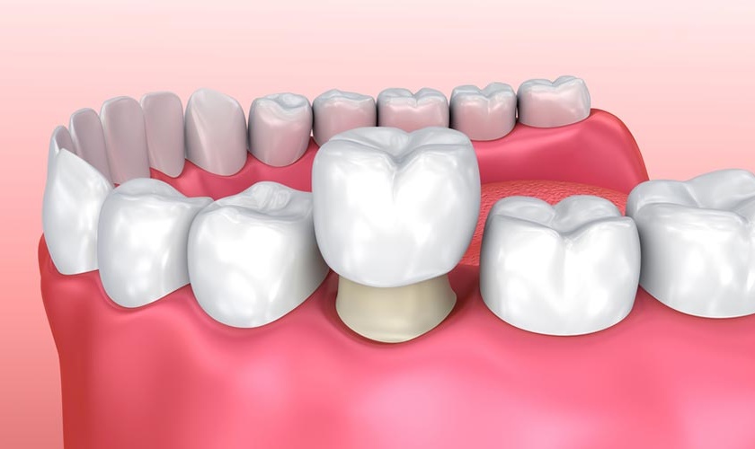 Có nên bọc răng sứ cho răng sâu?