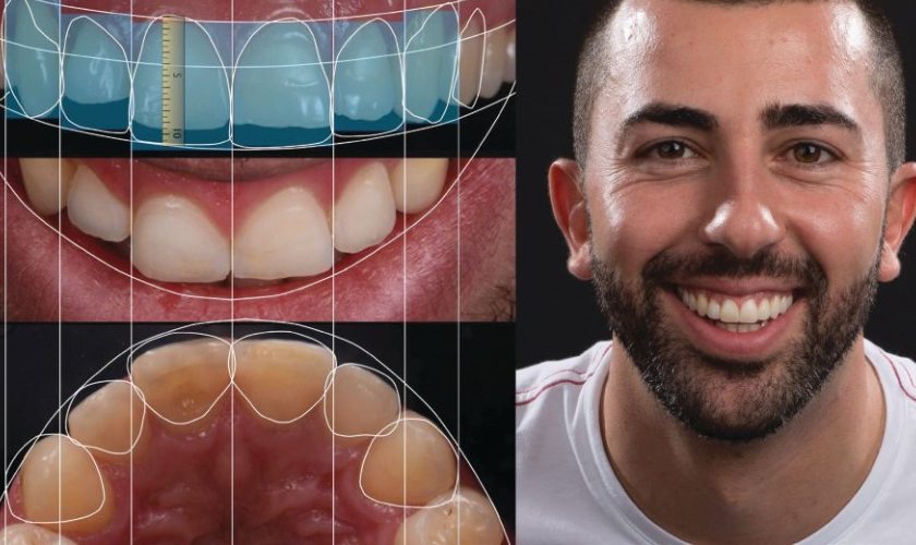 Thiết kế nụ cười trước khi làm răng sứ