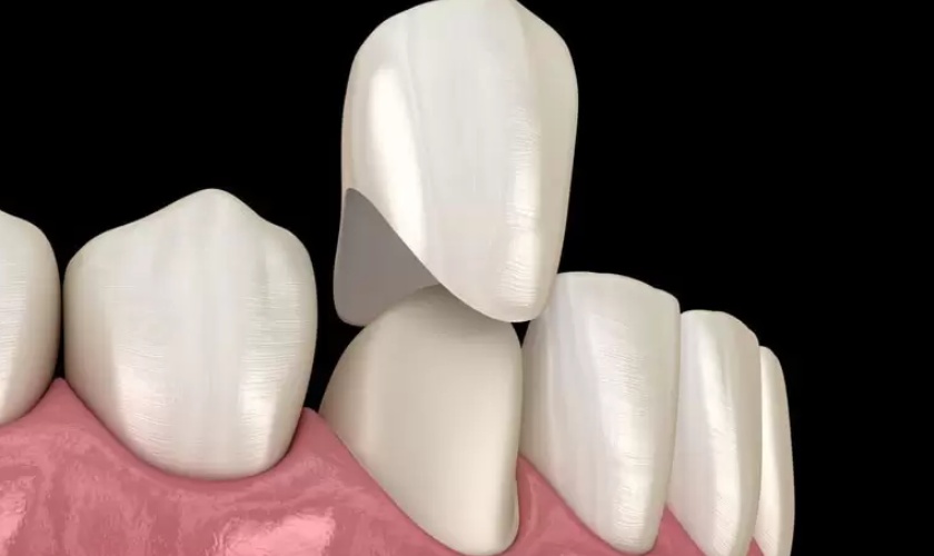 Chụp răng sứ được lắp lên một thân răng đã được mài đúng kỹ thuật