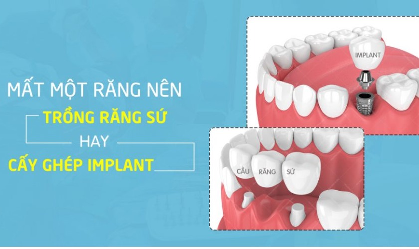 Mất một răng nên làm răng sứ hay cấy ghép implant